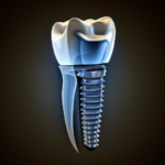 globalsonreir_dental_implant_b34fc102-46e3-4bf5-a1ec-a20905d56344_3